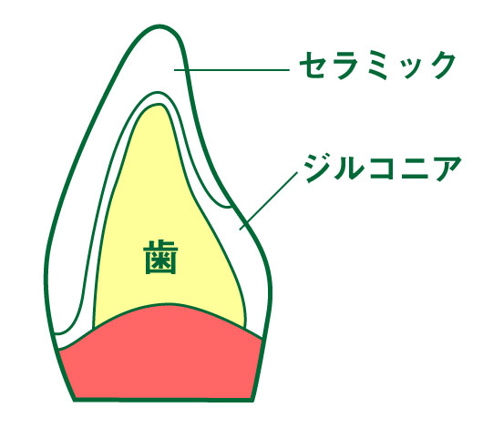 ジルコボンド