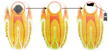 大きな虫歯がある歯