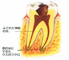 歯の中の悪いところを除去し清潔にしていきます。