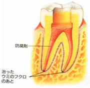 菌が入らないよう、根に防腐剤を詰め蓋をします。