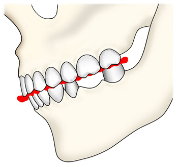 ＴＭＪ（顎関節機能障害）