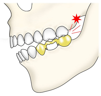 ＴＭＪ（顎関節機能障害）