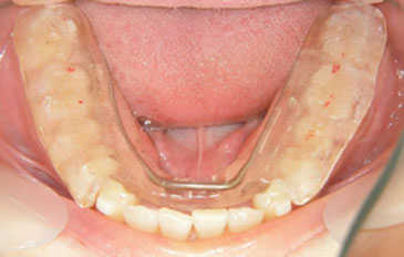 顎関節とマウスピース治療