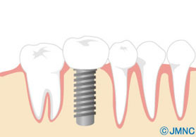 インプラントについて
